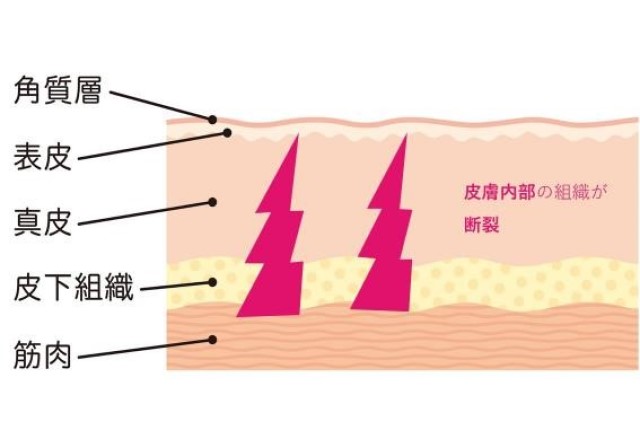 妊娠線　仕組み