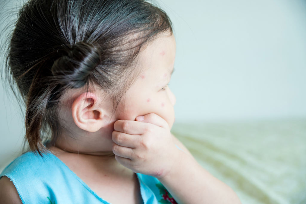 【医師監修】小学生の水疱瘡の治し方。登校OKの基準は？いつまでうつる？ | kosodate LIFE（子育てライフ）
