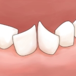 永久歯　生え方　斜め
