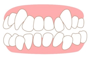 八重歯の生え始めの対処｜自力で治すことはできる？矯正の費用は？