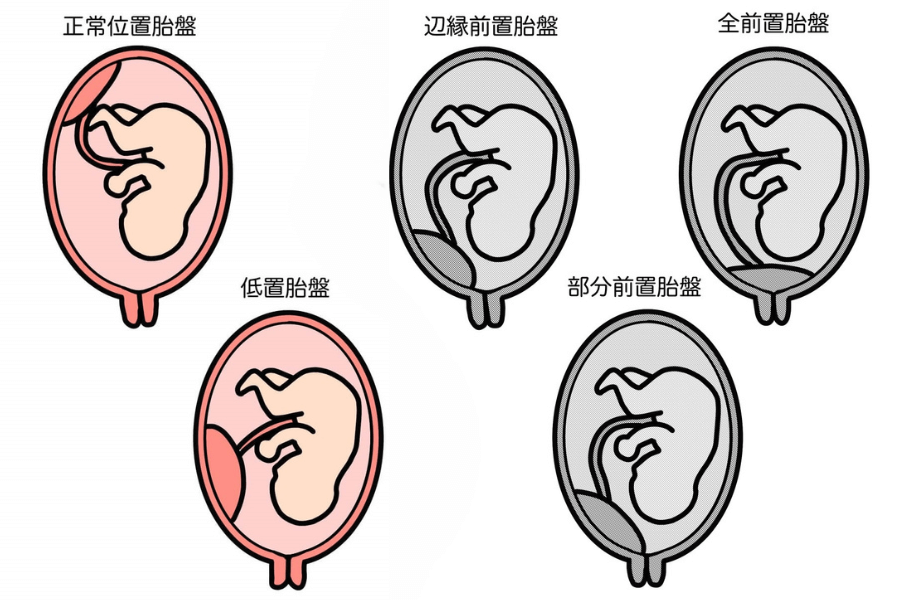 低置胎盤と前置胎盤の違い